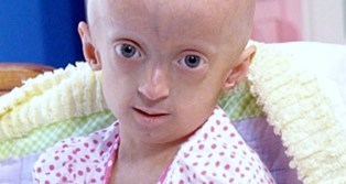 progeria縮小.jpg